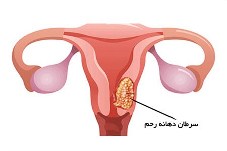 سرطان عنق رحم